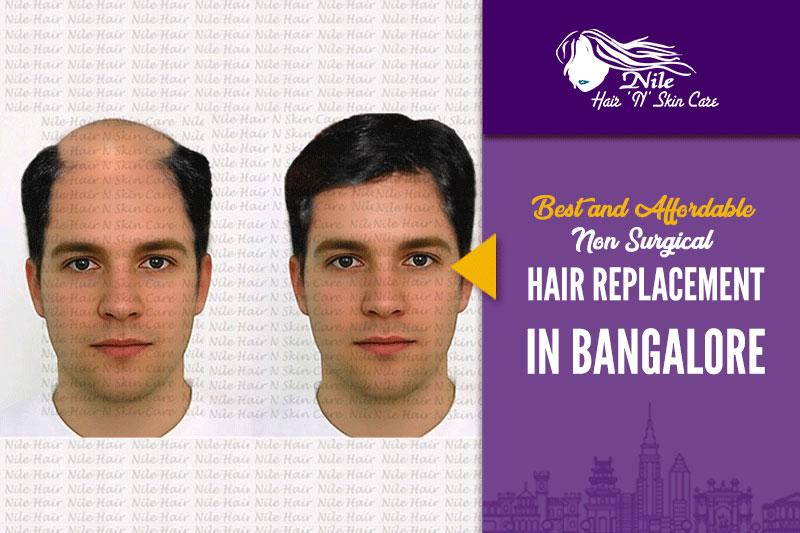 Best Hair Replacement in Bangalore