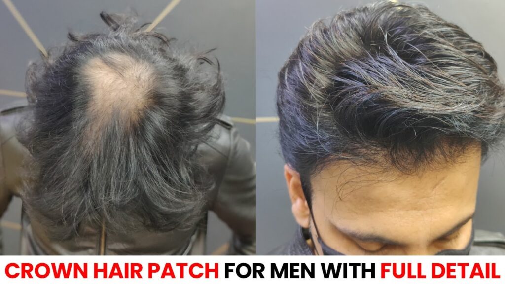 Hair Patch for Bald Spot
