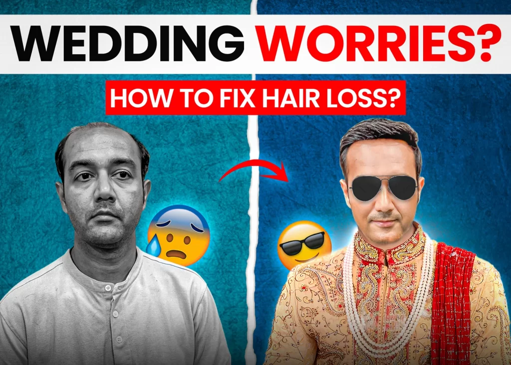 Wedding Stress Hair Loss