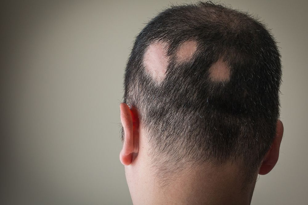 Bald Patches Without Surgery