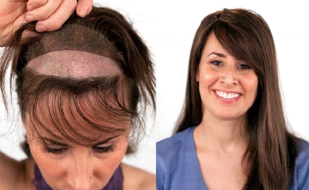 Hair Fixing Cost in Bangalore