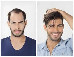 Hair Fixing for Weddings in Bangalore