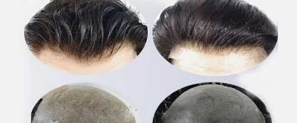 Wig vs Hair Patch