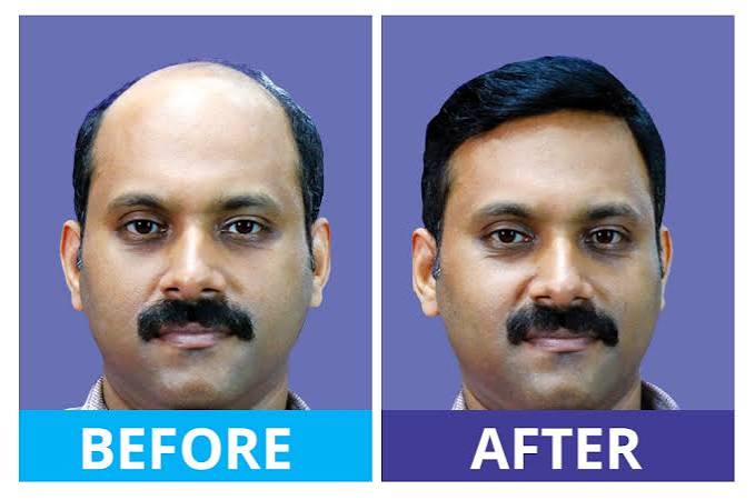 Hair Fixing in Bangalore