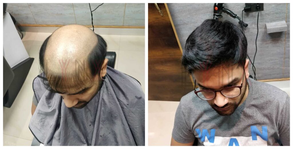 Hair Patch Service Near Me in Bangalore