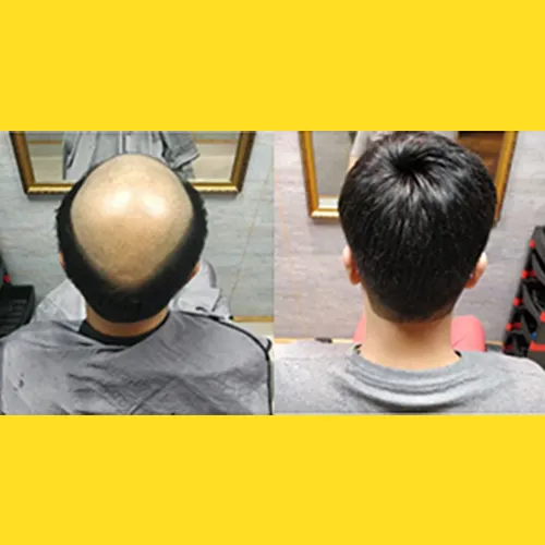 Hair Patch Service in Bangalore