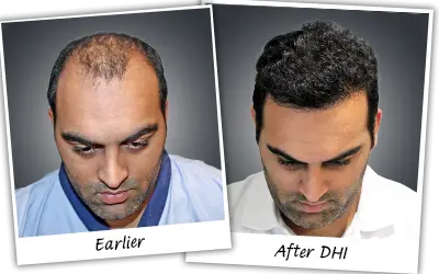 Permanent Hair Patch for Men in Bangalore