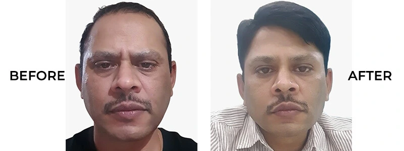 Best Hair Fixing Clinics Bellandur